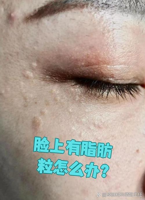 护肤品用着就长脂肪粒怎么办?-图2 护肤品用着就长脂肪粒怎么办?-图2