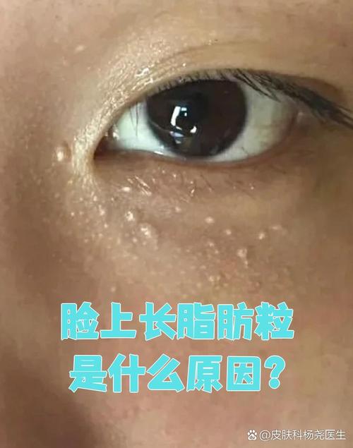 护肤品用着就长脂肪粒怎么办?-图3 护肤品用着就长脂肪粒怎么办?-图3