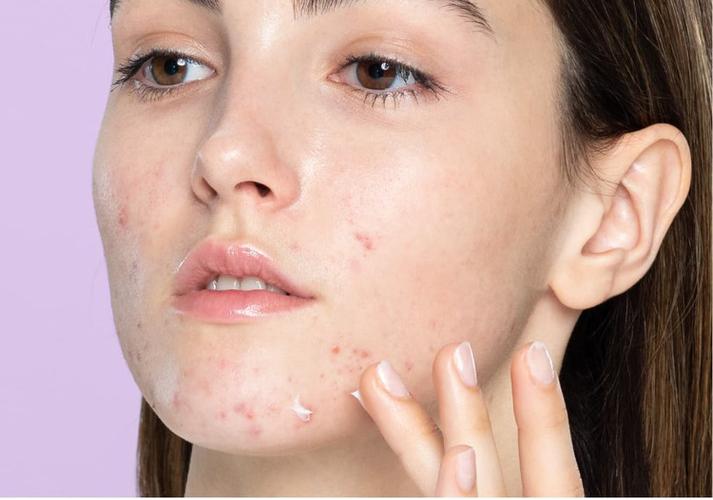 可伶可俐祛痘凝露为何突然停产？-图3