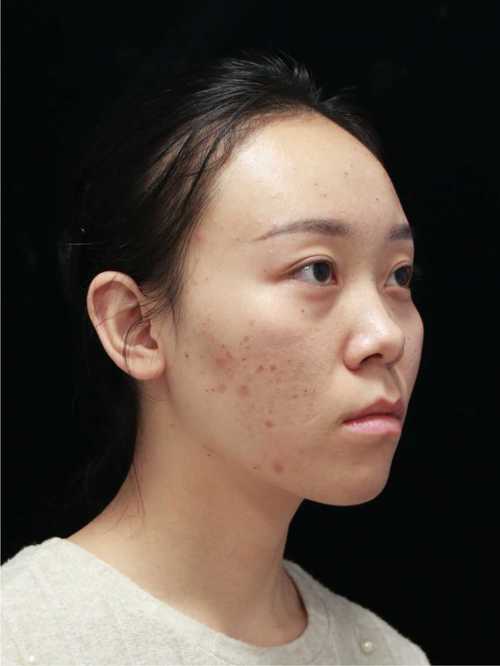 医院祛痘印效果真的好吗？-图3