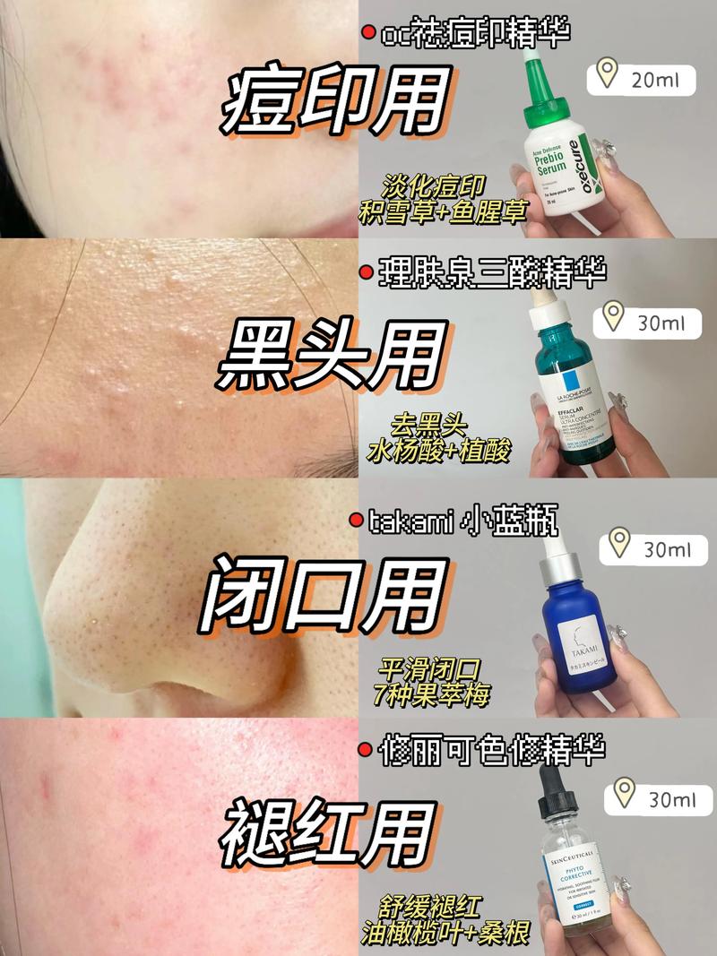 毕克护肤品祛痘真的有效吗？-图3