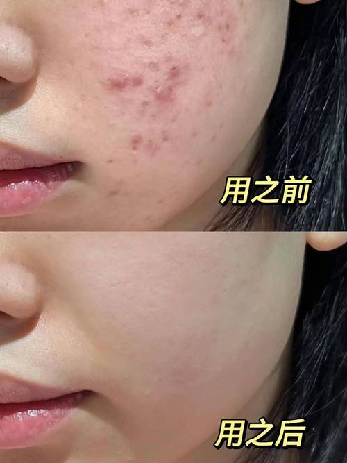 果酸祛痘效果真的好吗？-图3