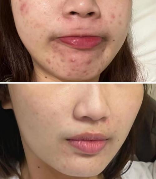 苹果祛痘印真的有效吗？-图2