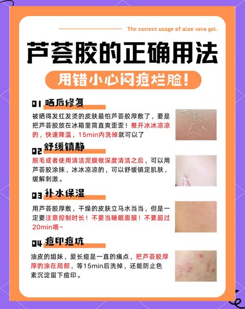 92芦荟胶真的能祛痘吗？-图1