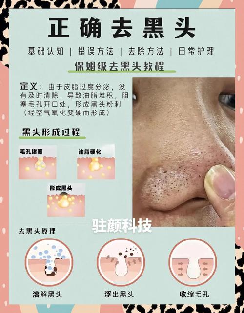 一天真能快速祛痘粉刺吗?-图2 一天真能快速祛痘粉刺吗?-图2