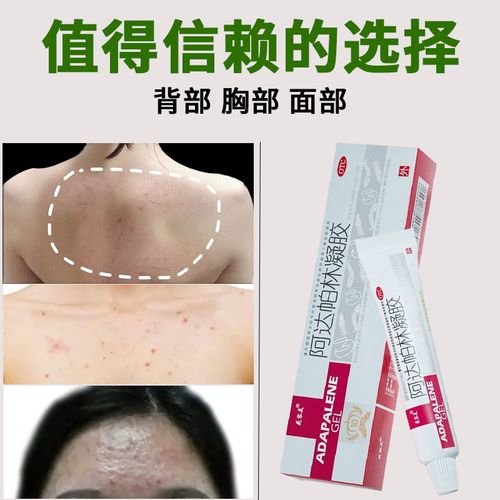 阿达帕林凝胶祛痘成功秘诀是什么?-图2 阿达帕林凝胶祛痘成功秘诀是什么?-图2