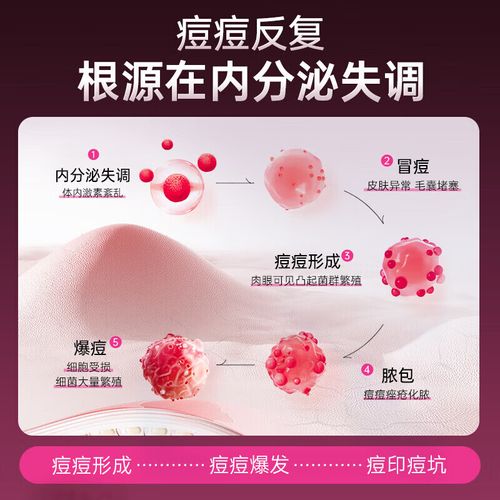 祛痘排毒药怎么选？哪种最有效？-图2