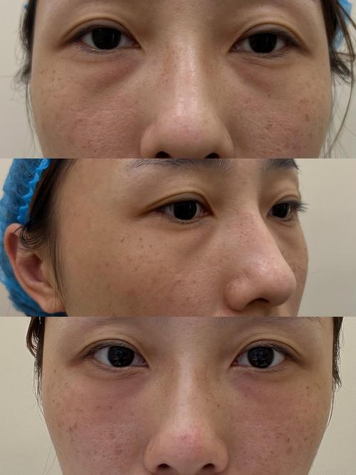 吃胶原蛋白真能祛痘坑吗？-图2