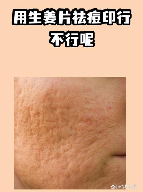 生姜祛痘印的原理是什么？-图1