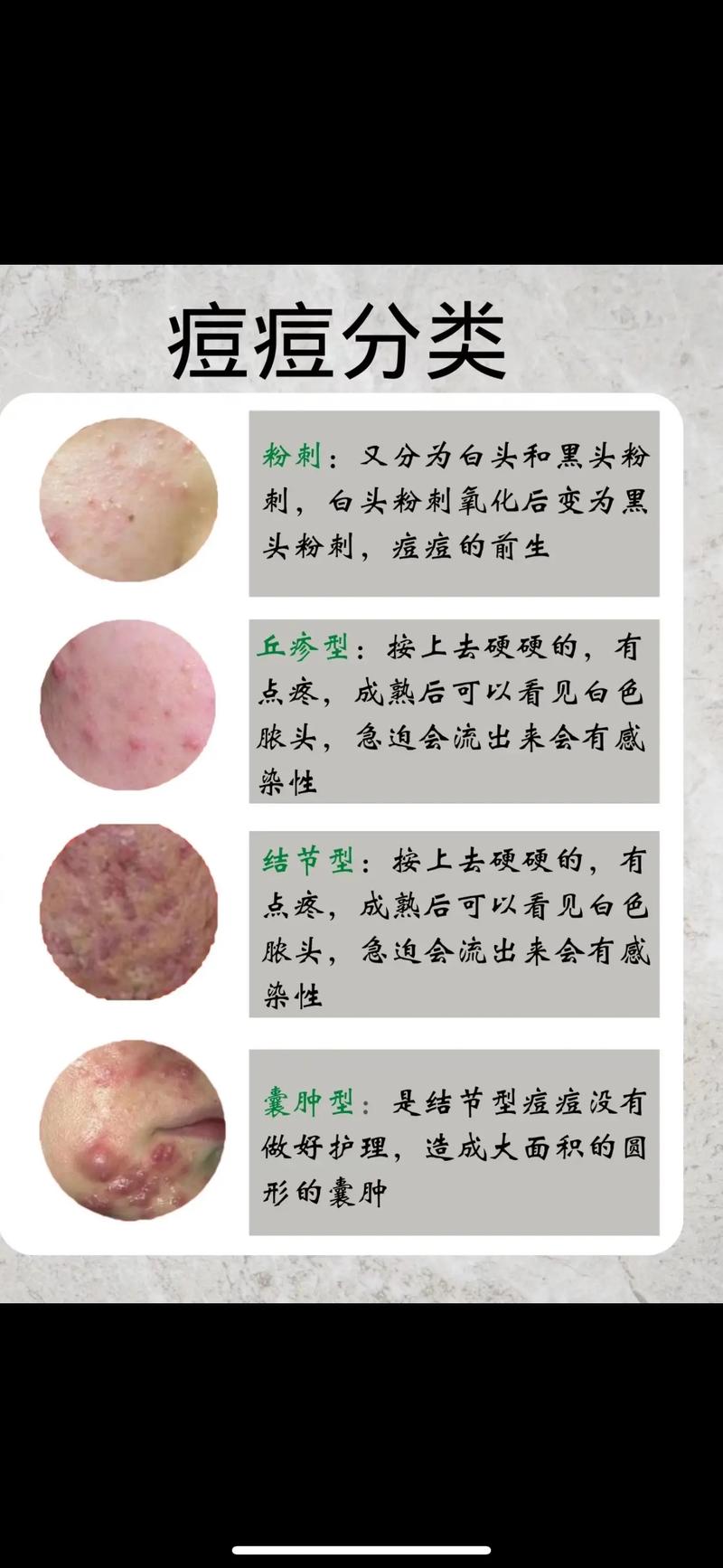 男士祛痘最有效方法到底有哪些？-图2