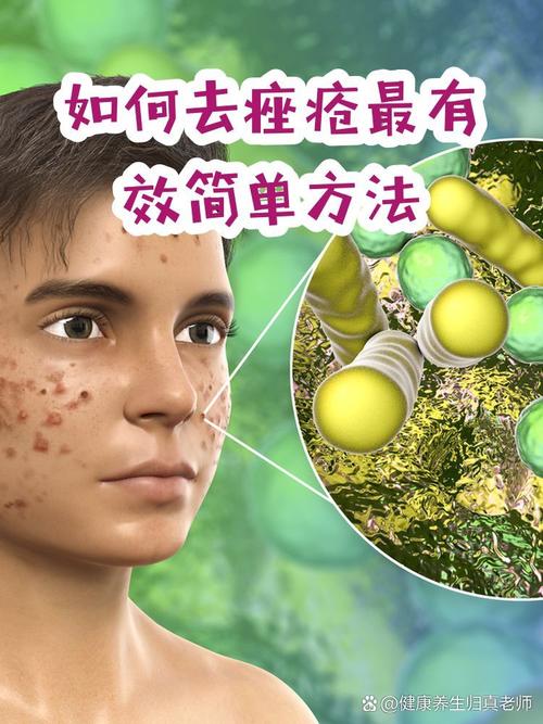 男士祛痘最有效方法到底有哪些？-图3