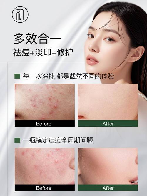 祛痘产品效果不佳怎么办？-图1