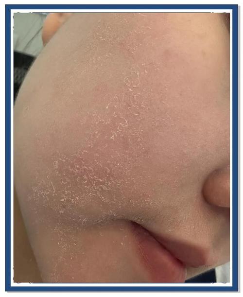 祛痘后皮肤发干怎么办？-图1