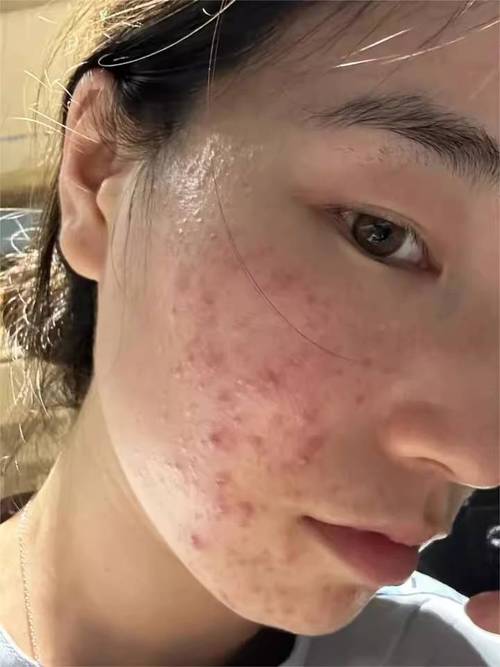 祛痘后皮肤发干怎么办？-图2