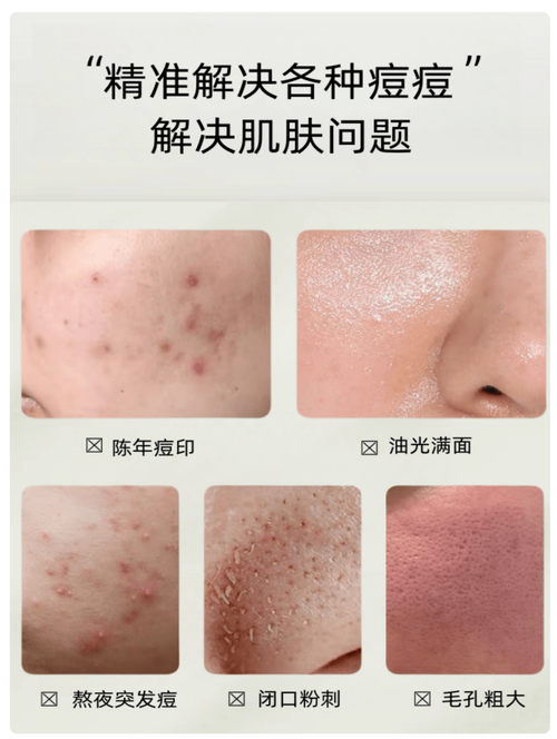 闭口粉刺护肤品怎么选才有效？-图3