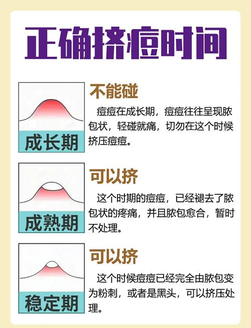 祛痘到底该怎么做才有效？-图2