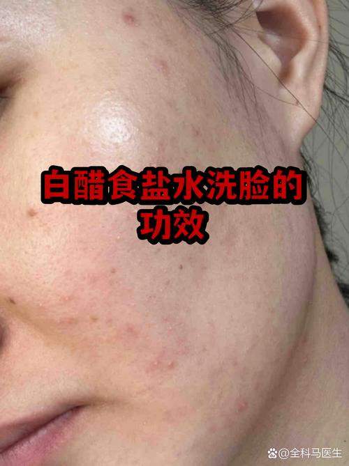 白醋盐水祛痘真有效吗？-图2