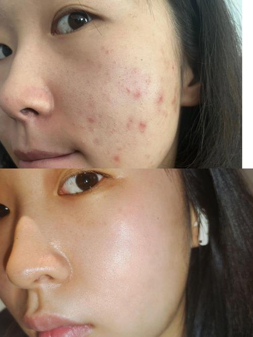 国外祛痘印效果最好的产品是哪个？-图2