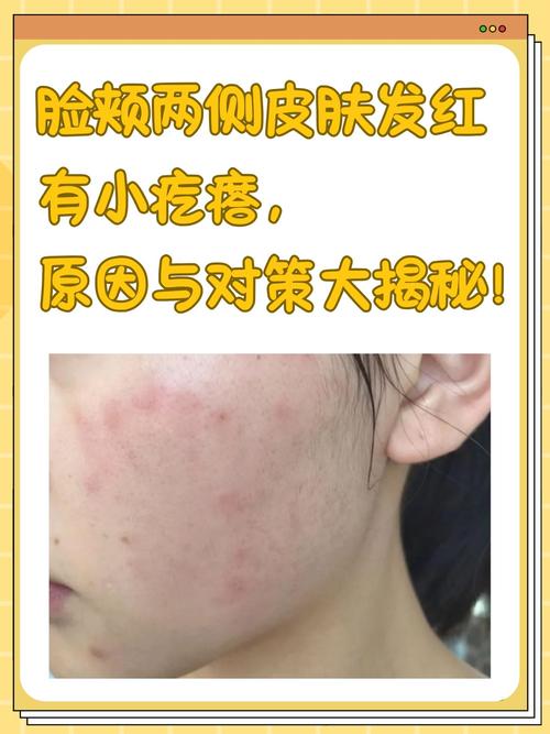 红蓝光祛痘会伤皮肤吗？-图2