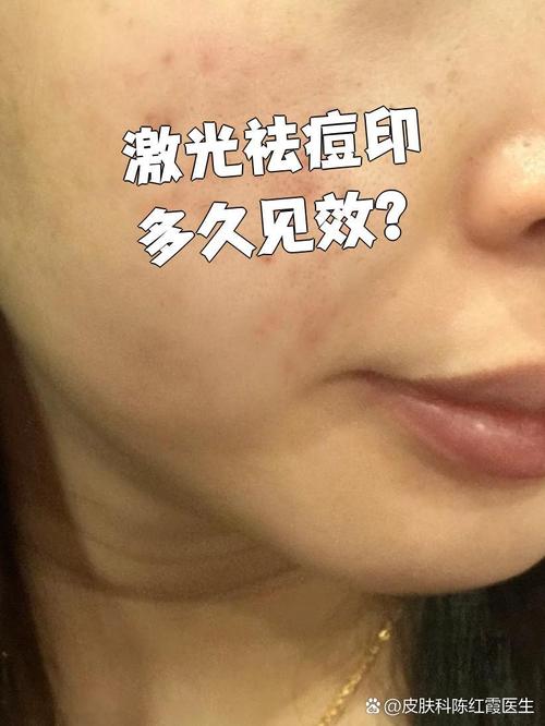 激光祛痘印效果到底怎么样?-图2 激光祛痘印效果到底怎么样?-图2