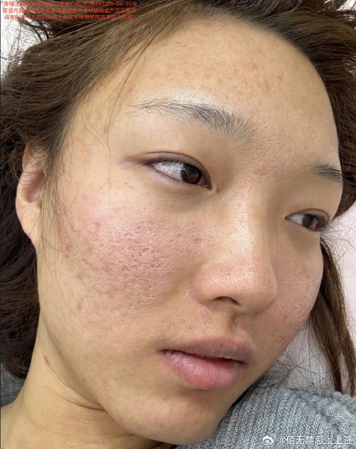 激光祛痘坑真没效果吗？-图1