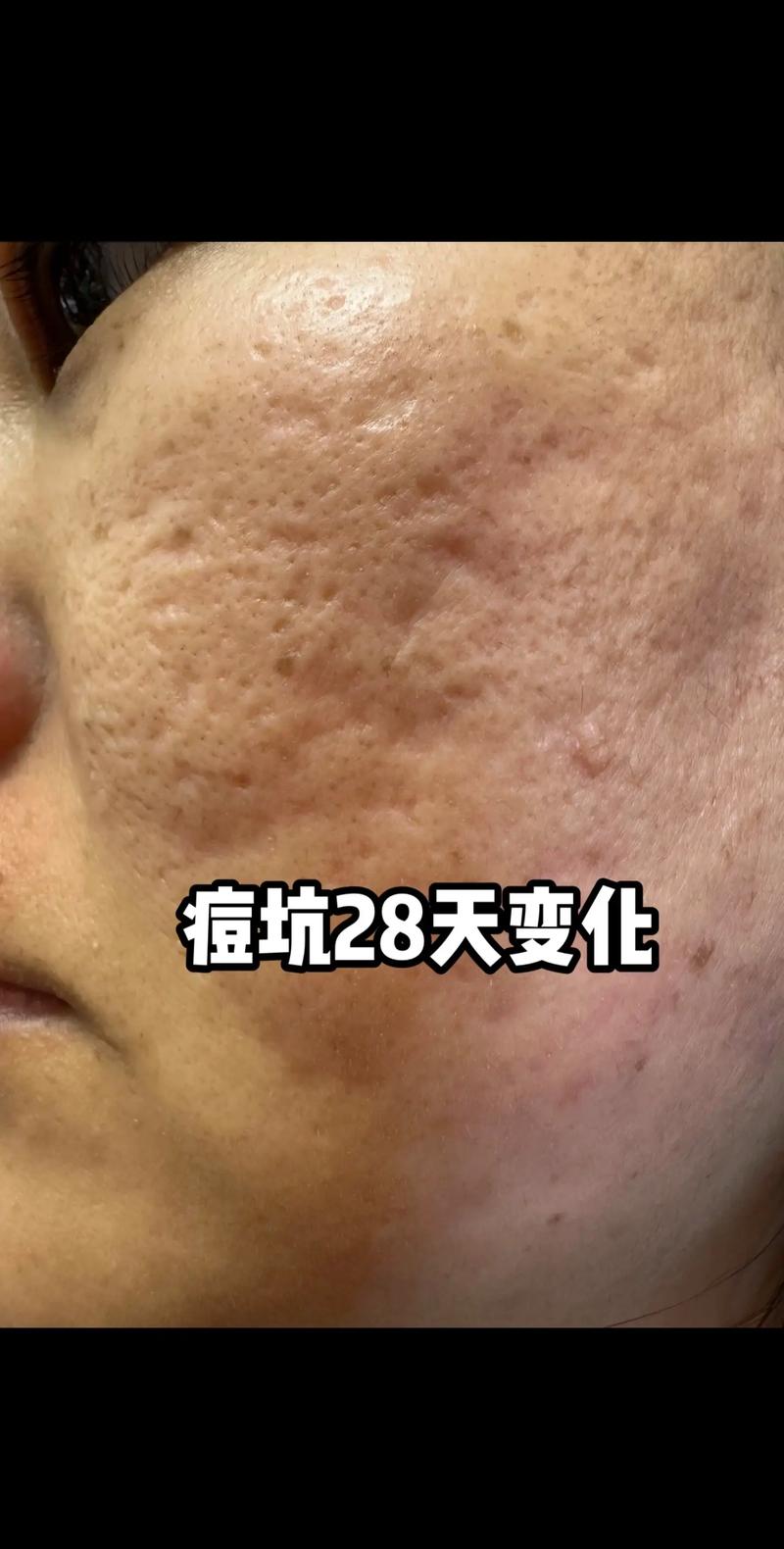 激光祛痘坑真没效果吗？-图2