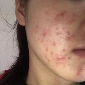 激光祛痘和红蓝光是一回事吗？-图3