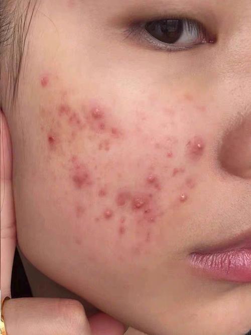 热水白糖祛痘印真有效吗？-图3