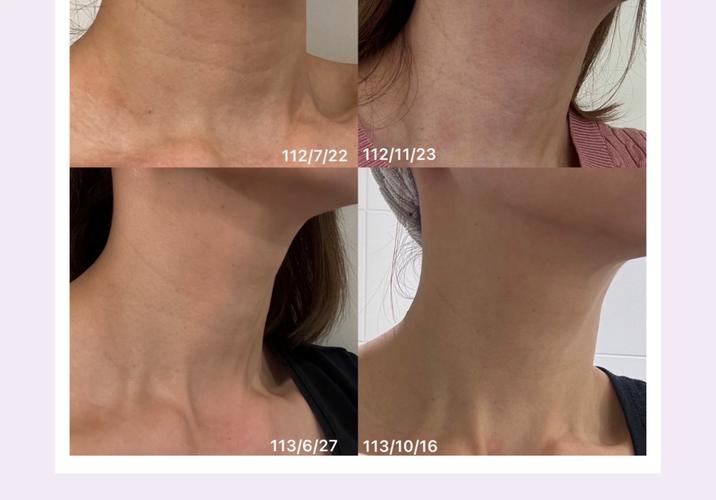 脂肪填充后护肤品怎么选?-图1 脂肪填充后护肤品怎么选?-图1