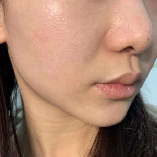 激光祛痘几天后能化妆?-图3 激光祛痘几天后能化妆?-图3