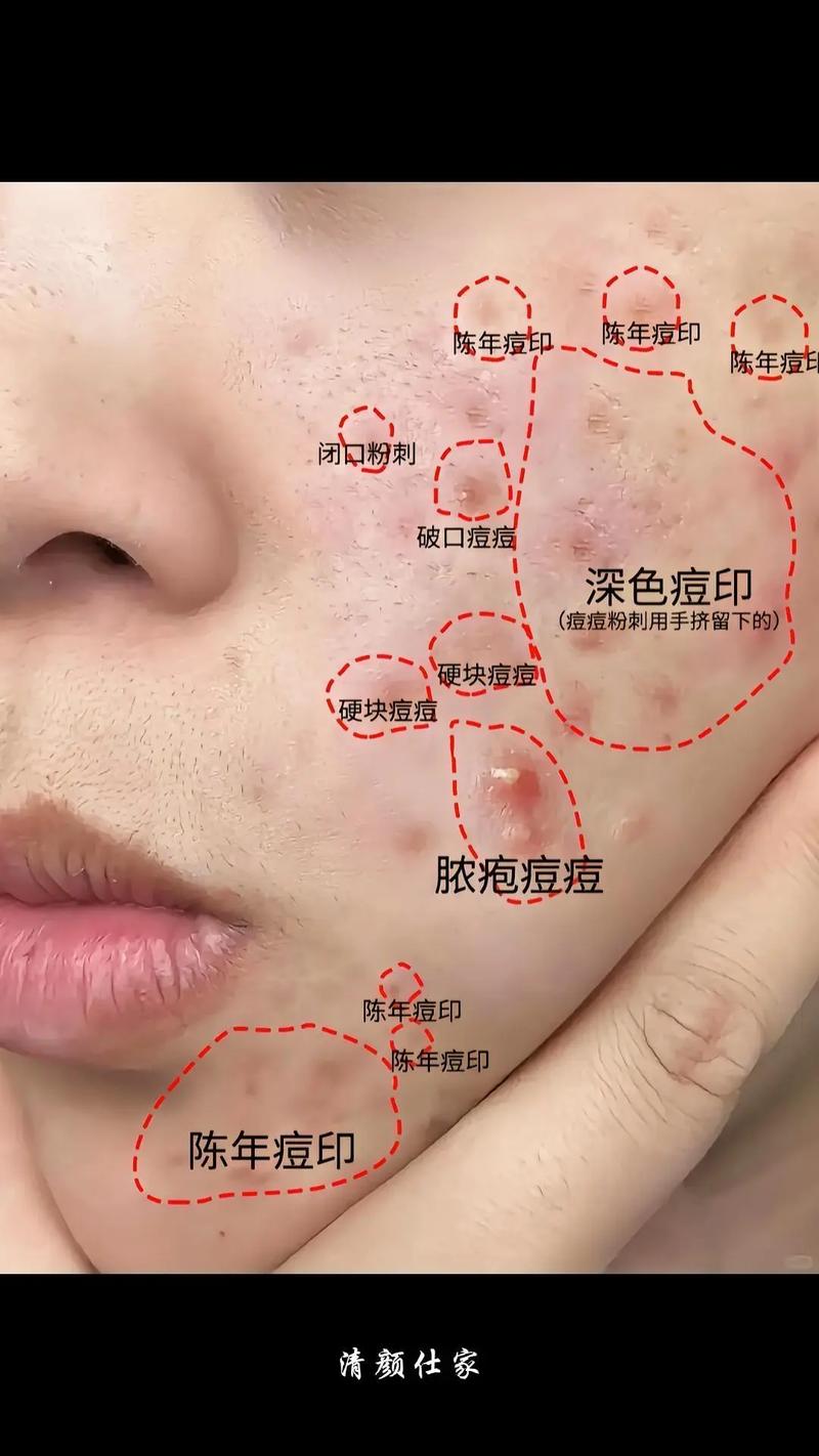 祛痘后如何护理不留痘印?-图2 祛痘后如何护理不留痘印?-图2