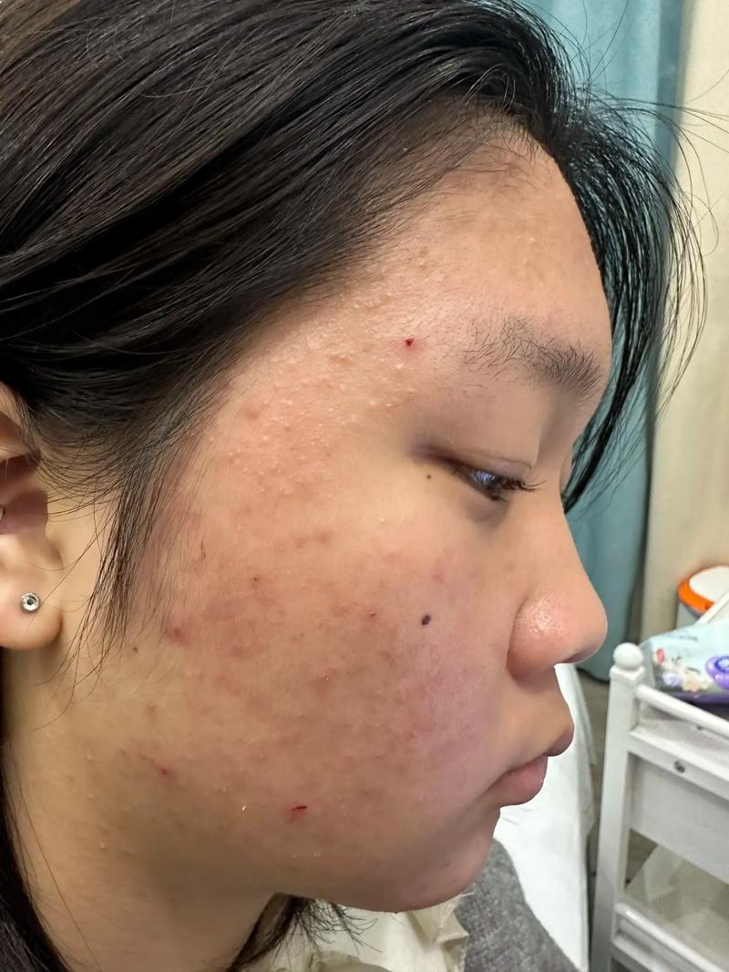 果酸祛痘后效果能持久吗?-图1 果酸祛痘后效果能持久吗?-图1