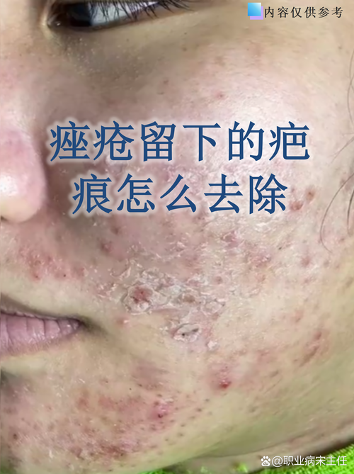 果酸祛痘后效果能持久吗?-图3 果酸祛痘后效果能持久吗?-图3