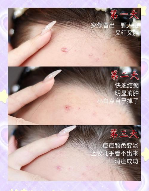 简单自制祛痘方法大全-图3