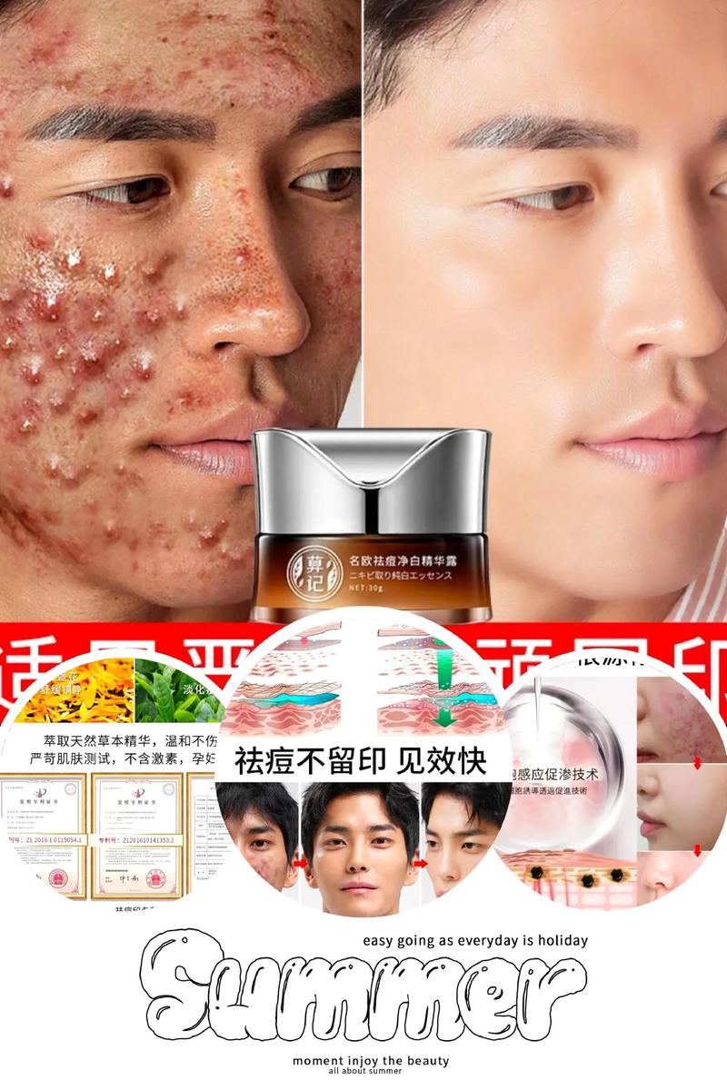 祛痘印痘坑，用什么最有效？-图2
