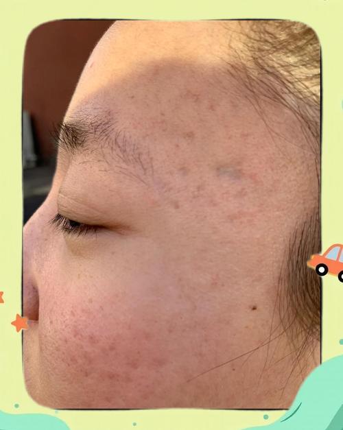 激光祛痘印会留痘坑吗？-图1