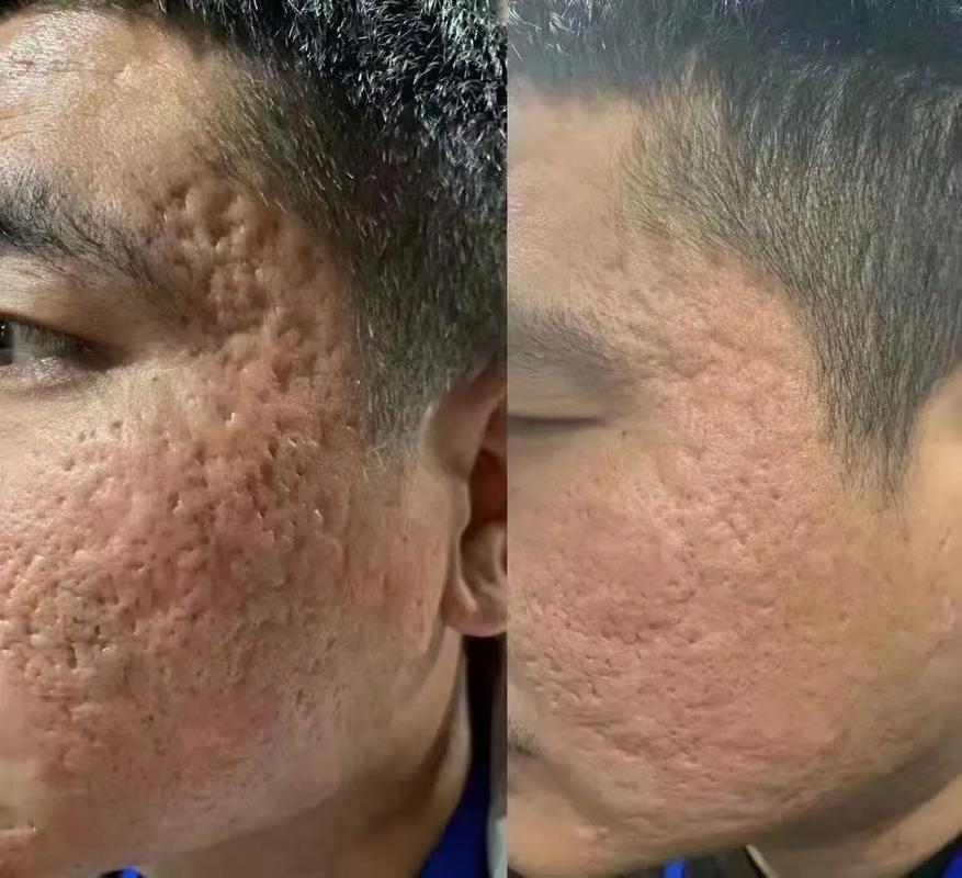 激光祛痘印会留痘坑吗？-图3