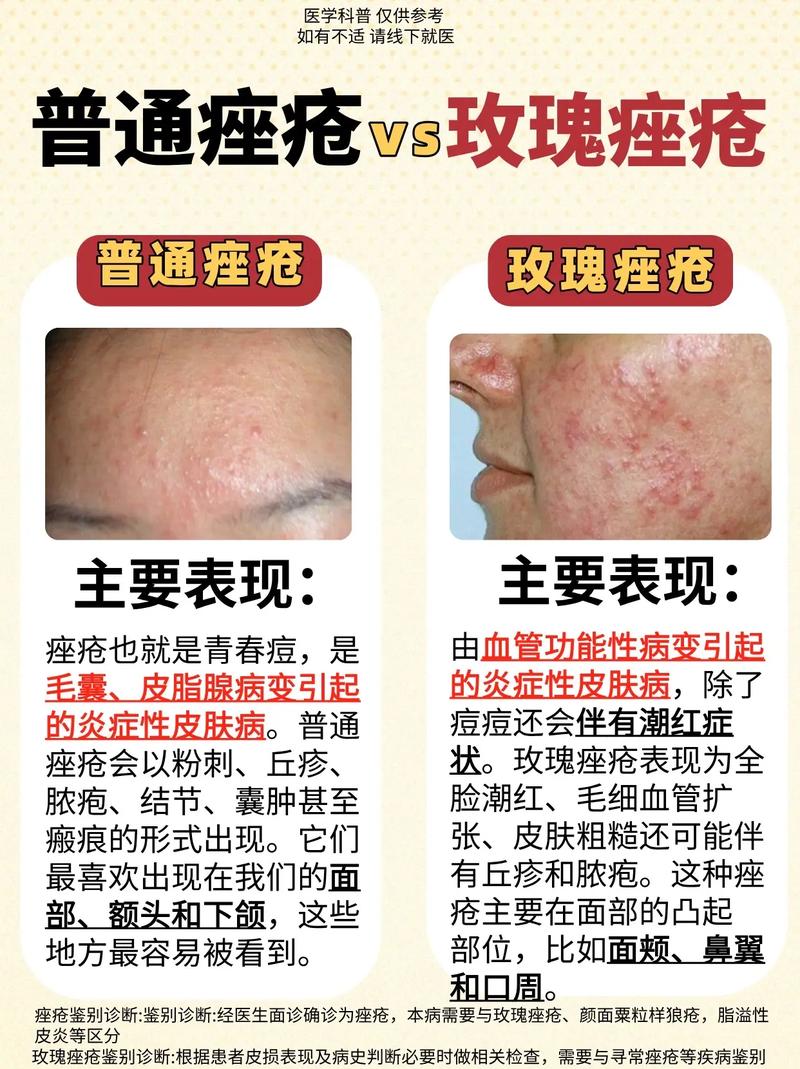 抗痘和祛痘，是一回事还是两回事？-图2