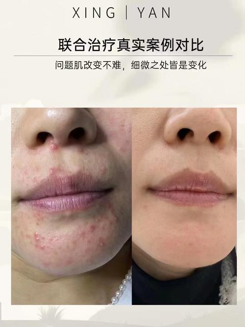 抗痘和祛痘，是一回事还是两回事？-图1