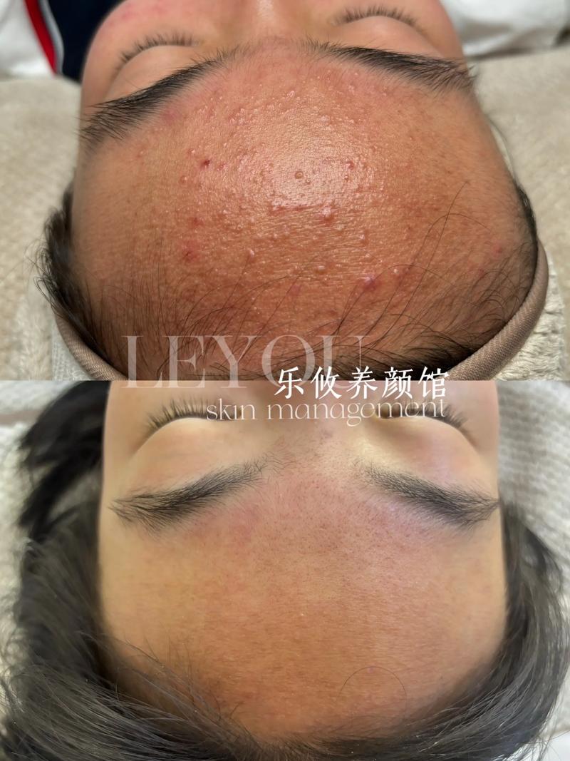 抗痘和祛痘，是一回事还是两回事？-图3