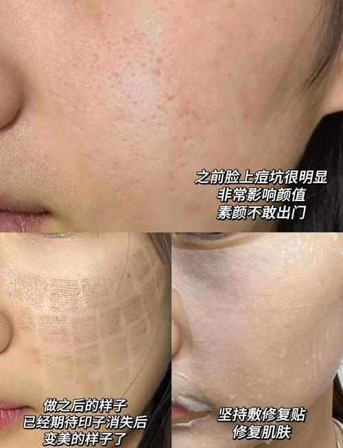 激光祛痘能同时去痘坑吗？-图2