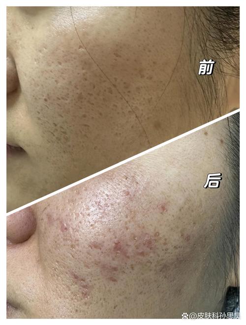 激光祛痘能同时去痘坑吗？-图3