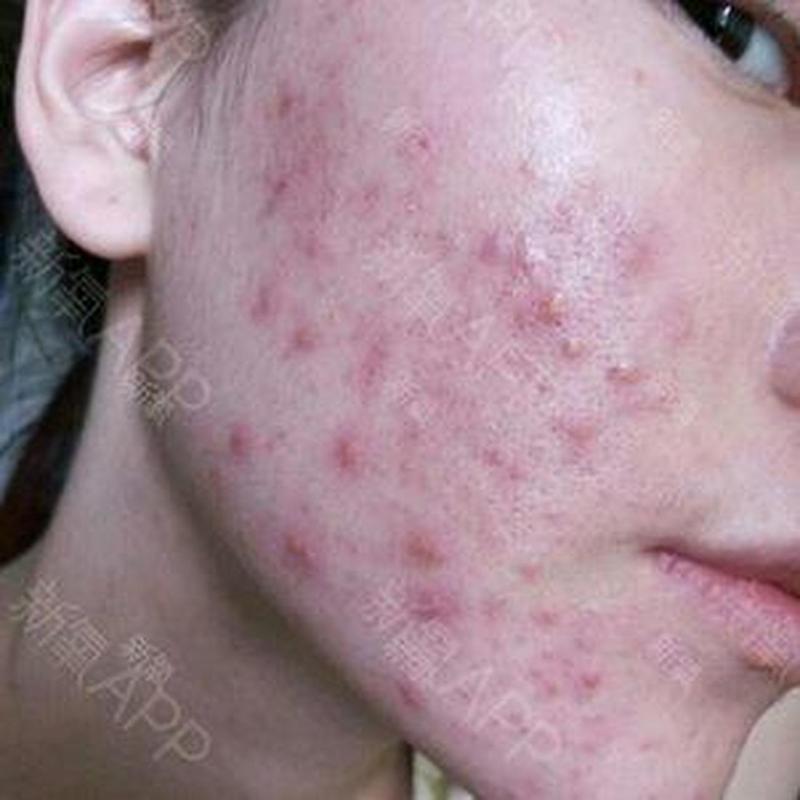 红蓝光祛痘期间能挤痘吗?-图3 红蓝光祛痘期间能挤痘吗?-图3