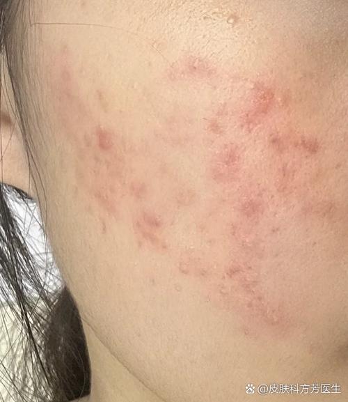 红蓝光祛痘期间能挤痘吗?-图2 红蓝光祛痘期间能挤痘吗?-图2