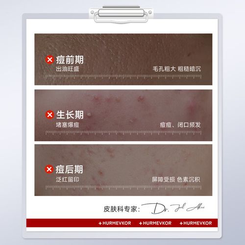 祛痘印、缩毛孔，护肤品真能兼顾吗？-图2