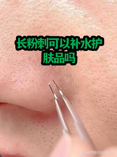 长粉刺能用护肤品吗？-图3