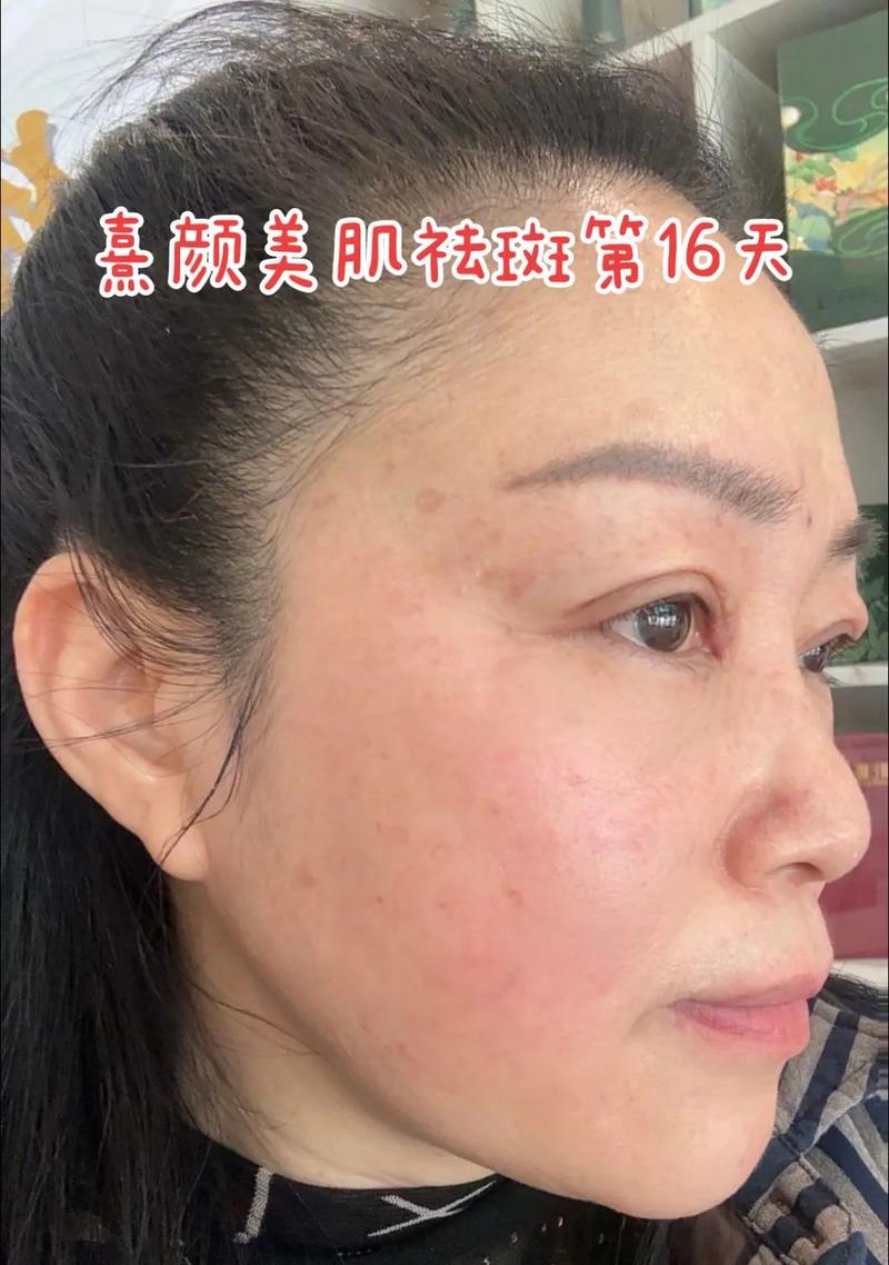 激光祛斑能同时祛痘印吗?-图1 激光祛斑能同时祛痘印吗?-图1