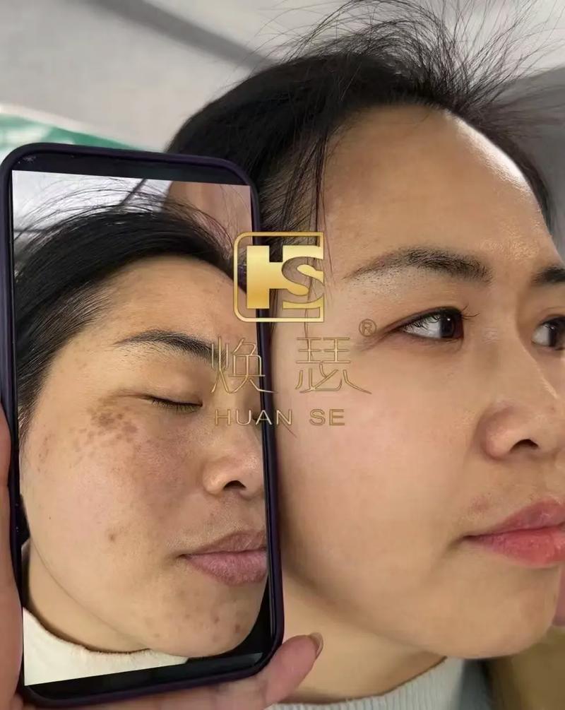 激光祛斑能同时祛痘印吗?-图2 激光祛斑能同时祛痘印吗?-图2