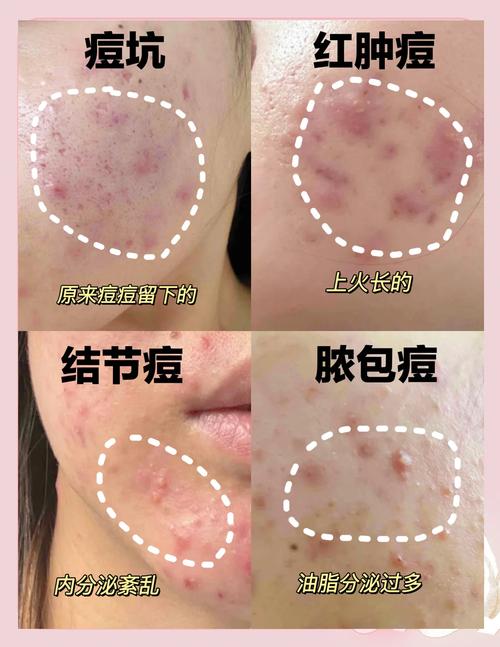 Clinique祛痘效果到底怎么样?-图2 Clinique祛痘效果到底怎么样?-图2