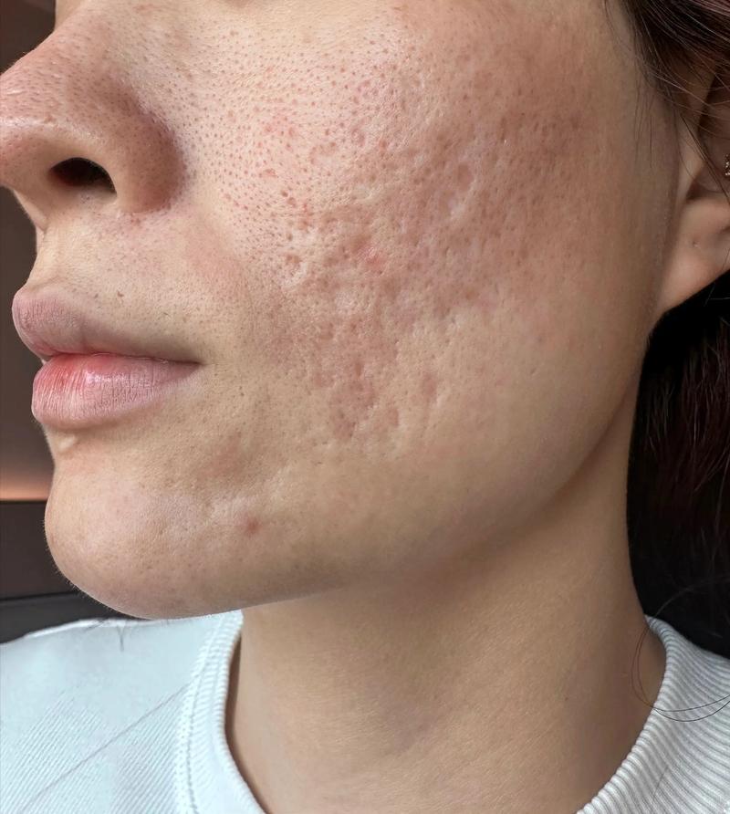 痘印、痘疤、痘坑,如何有效祛除?-图1 痘印、痘疤、痘坑,如何有效祛除?-图1